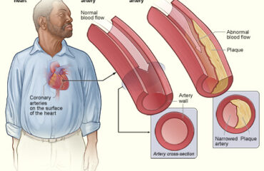 Aterosclerosis y placa arterial Ilustración médica de arteria normal y arteria con placa aterosclerótica