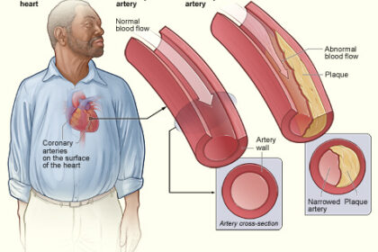 Aterosclerosis y placa arterial Ilustración médica de arteria normal y arteria con placa aterosclerótica