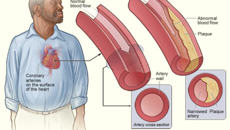 Ilustración médica de arteria normal y arteria con placa aterosclerótica