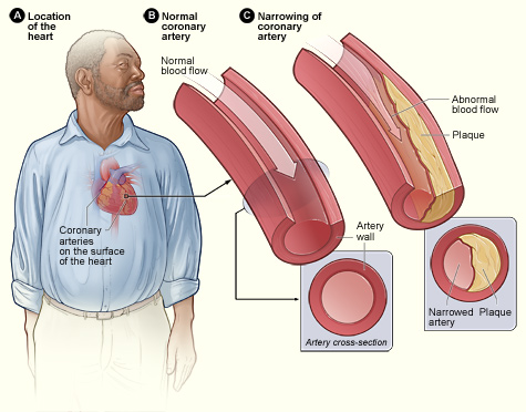 Ilustración médica de arteria normal y arteria con placa aterosclerótica