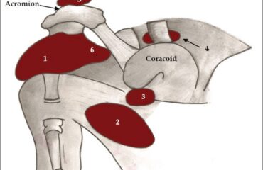 Diagrama anatómico de bursas alrededor de la articulación del hombro