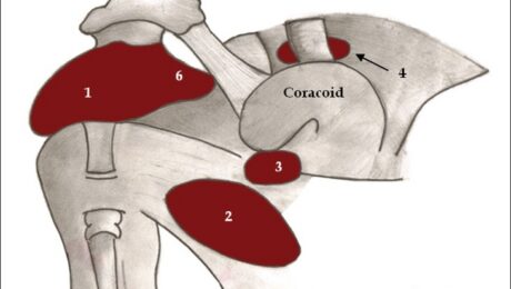 Diagrama anatómico de bursas alrededor de la articulación del hombro
