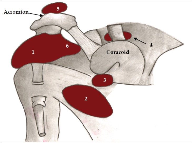 Diagrama anatómico de bursas alrededor de la articulación del hombro