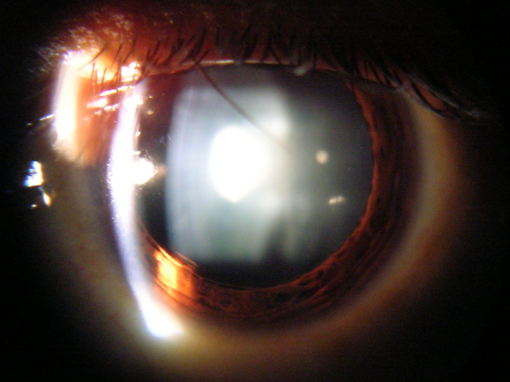 Vista con lámpara de hendidura de una catarata en ojo humano