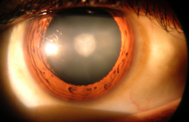 Catarata en ojo humano Ojo humano con catarata visible en el cristalino