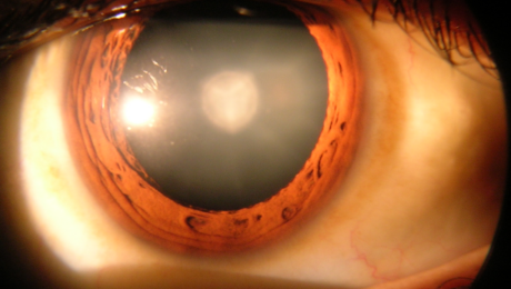 Ojo humano con catarata visible en el cristalino