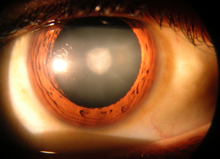 Ojo humano con catarata visible en el cristalino