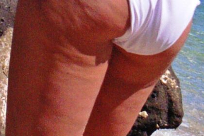 Aspecto de piel con celulitis estética Piel con aspecto irregular o piel de naranja asociado a celulitis estética