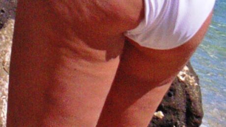 Piel con aspecto irregular o piel de naranja asociado a celulitis estética