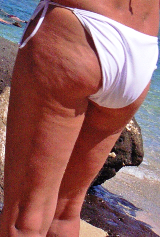 Piel con aspecto irregular o piel de naranja asociado a celulitis estética