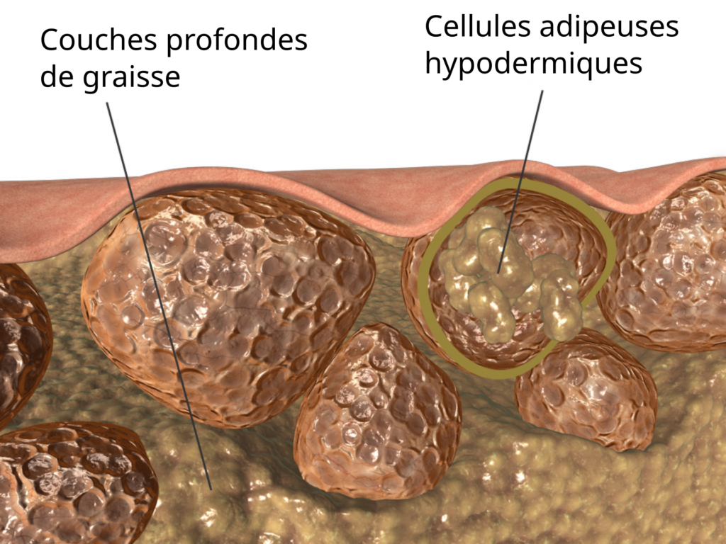 Ilustración anatómica de tejido subcutáneo y celulitis