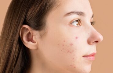 Acné y piel Rostro con acné como imagen educativa sobre piel y Ayurveda