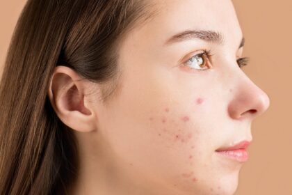 Rostro con acné como imagen educativa sobre piel y Ayurveda
