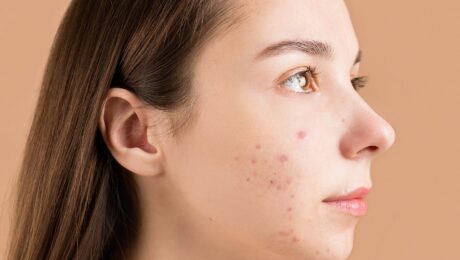 Rostro con acné como imagen educativa sobre piel y Ayurveda