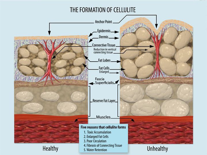 Diagrama sobre formación de celulitis en tejido subcutáneo