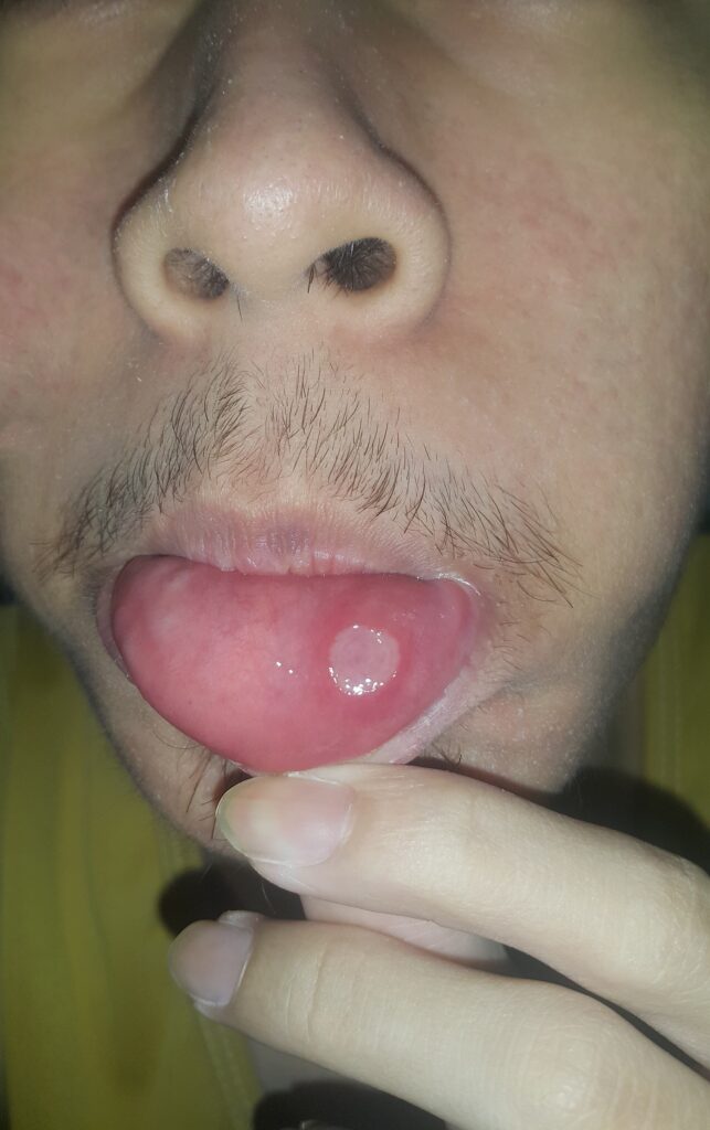 Foto médica de afta o llaga en la mucosa oral