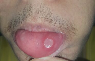 Afta bucal en mucosa oral Foto médica de afta o llaga en la mucosa oral
