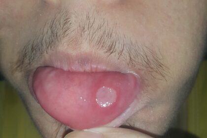 Afta bucal en mucosa oral Foto médica de afta o llaga en la mucosa oral