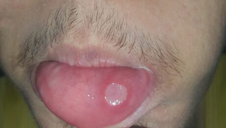 Foto médica de afta o llaga en la mucosa oral