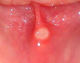 Afta oral ubicada en la parte interna del labio inferior